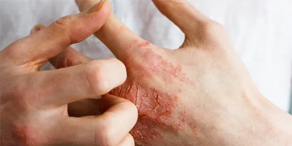 Dłonie o przesuszonej, popękanej i zaczerwienionej skórze